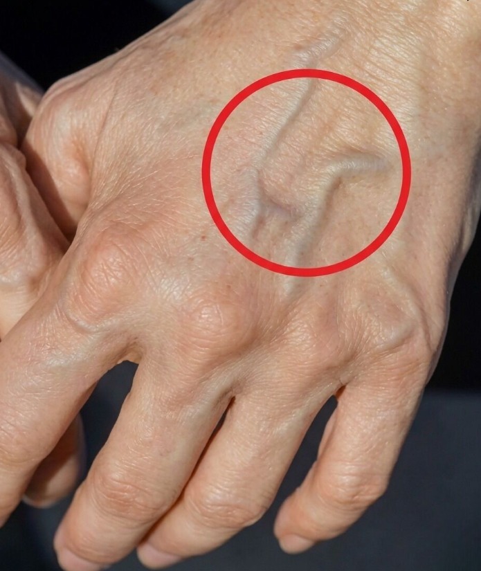 Are the Veins on Your Hands Telling You Something About Your Kidneys?