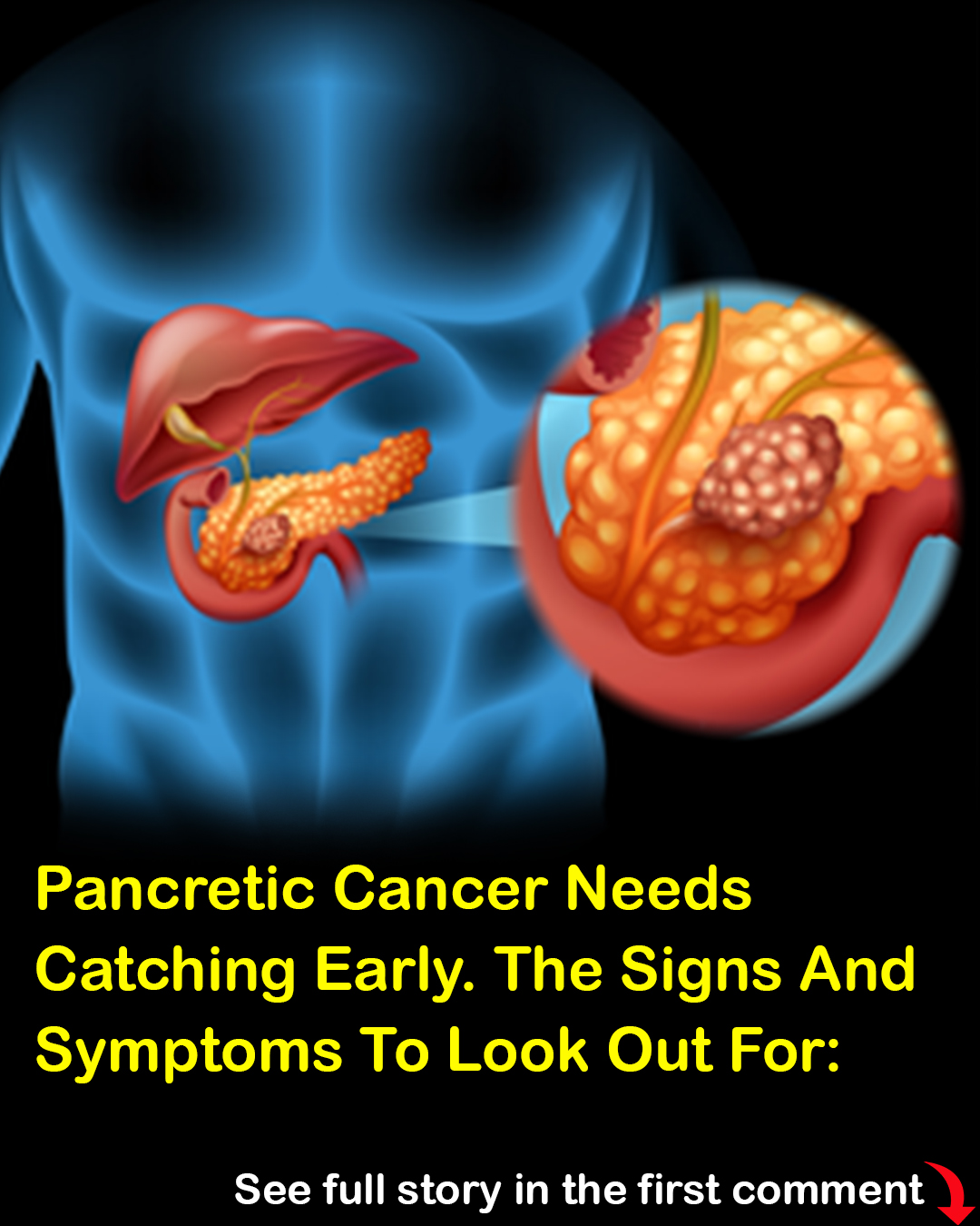 How your bowel movements can signal colon cancer