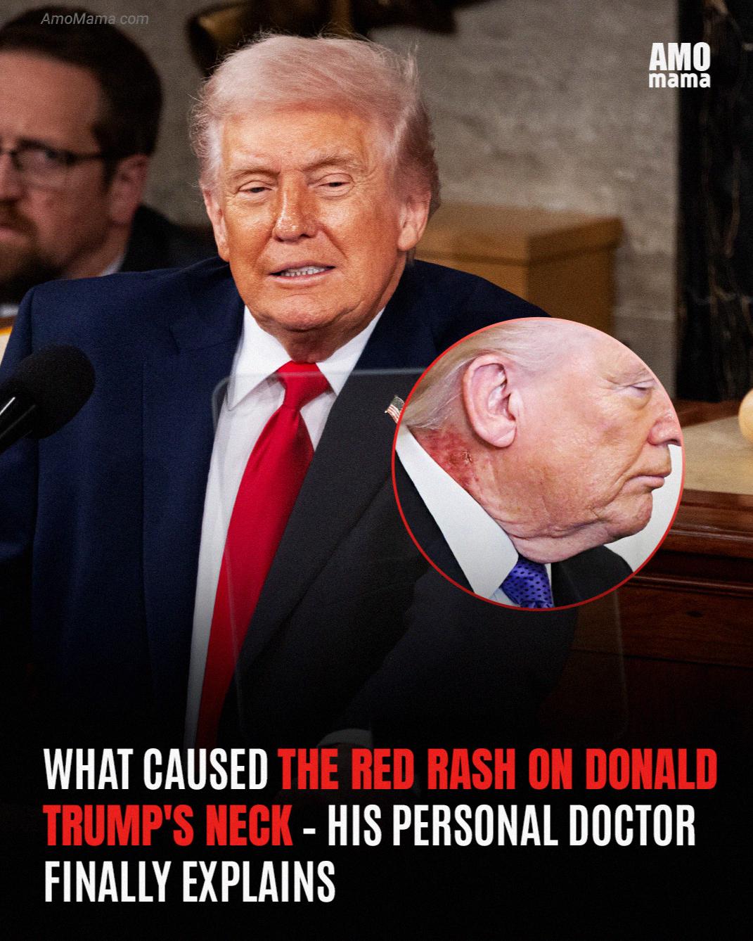 What’s Behind the Rash on Donald Trump’s Neck – His Doctor Breaks Silence