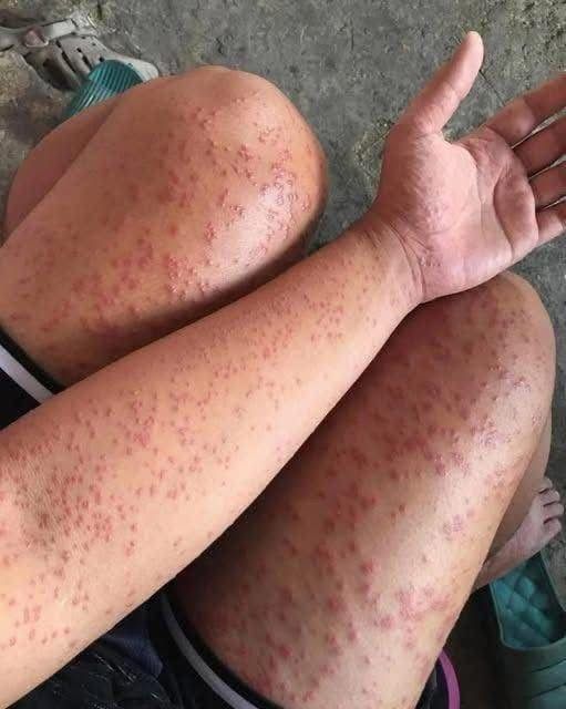 The Hidden Killer In Your Bed Why Waking Up With These Itchy Red Patches Is A High Stakes Medical Emergency That Could Shut Down Your Ability To Breathe In Minutes-
